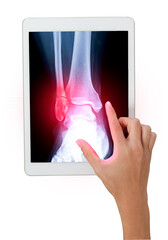 Poster - a hand gestures towards a tablet displaying an x-ray of an ankle showing a fibula bone fracture isol