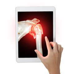 Poster - A hand gestures towards a tablet displaying a 3D rendering of a shoulder showing a humerus bone fracture isolated on white background. Clipping path.