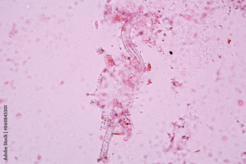 Threadworm Stool Sample View in microscopic Strongyloides stercoralis or threadworm in human ...