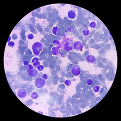 Poster - BMS (bone marrow study) : Reactive marrow. Megakaryocytes and plasma cells increased.