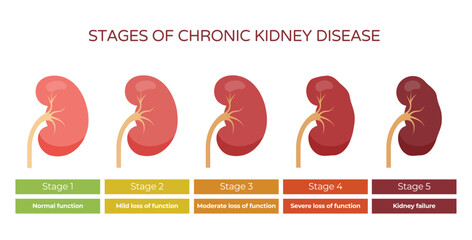 Kidney disease stages. Failure or chronic disease kidneys stages chart, hemodialysis diagnosis outbreak ache from stone infection treatment clinic infographic illustration