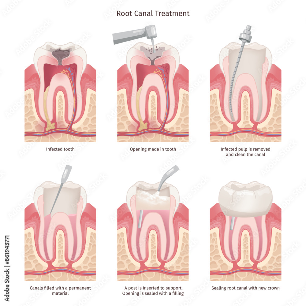 root-canal-treatment-tooth-canal-rooth-filling-endodontic-procedure