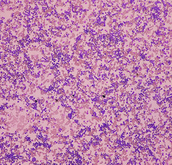 Poster - Acute myeloid leukemia (AML). Smear show monocytes and mostly blast cell. Anemia and thrombocytopenia. Most common acute leukemia affecting adults.