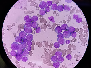 Sticker - Acute myeloid leukemia (AML). Smear show monocytes and mostly blast cell. Anemia and thrombocytopenia. Most common acute leukemia affecting adults.