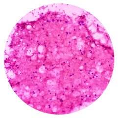 Sticker - Photomicrograph of Osteolytic lesion of left proximal radium, Positive for malignant cell, small blue round cell tumor, ewing's sarcoma, PNET, metastatic carcinoma.