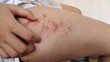 © Rung Kh - close up of a patient scratching the rash hives allergy and inflammation skin, reaction and urticaria, scar and acne on the leg of the woman, health care and medical concept.