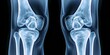 © Supremetones - Detailed X-ray Image of Human Knee Joints in Medical Diagnostic Setting