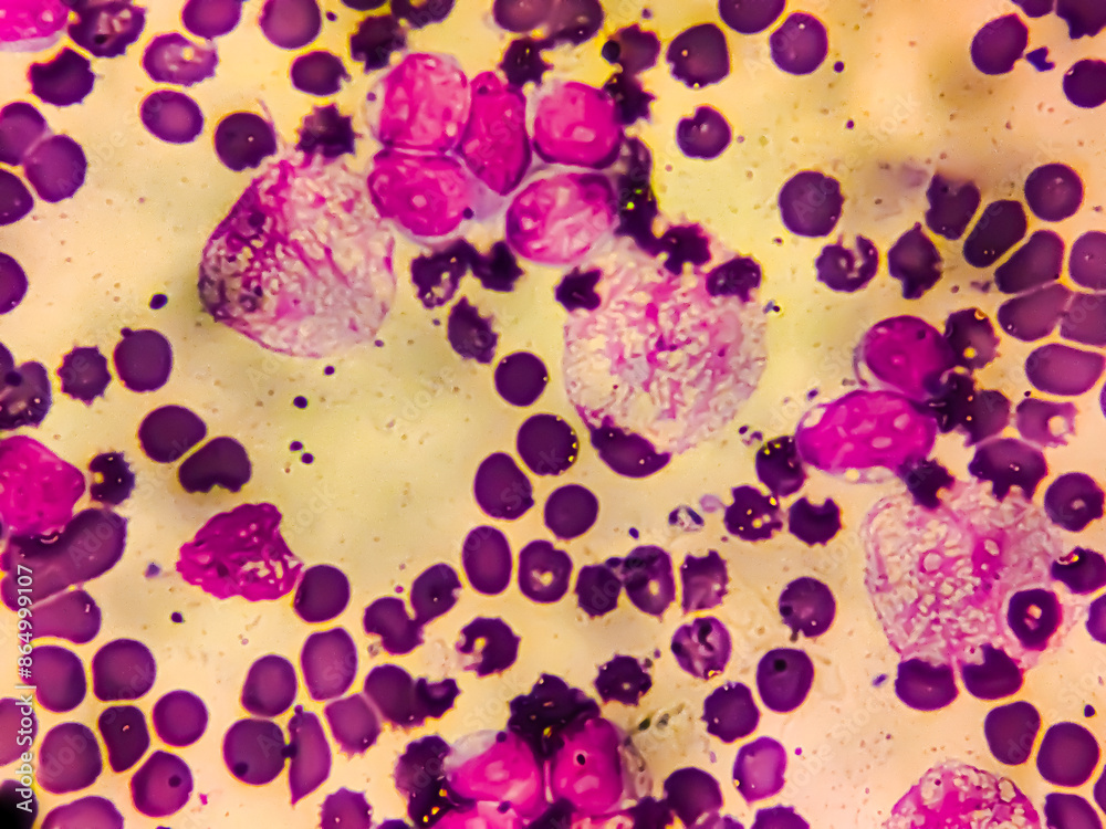Acute lymphoblastic leukemia (ALL), Mature B-cell analysed by light ...
