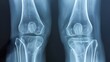 © thanarak - Detailed Knee X Ray Showing Potential Joint Problems and Medical Conditions