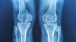© thanarak - Detailed X ray Image of Knee Joint Showcasing Medical Diagnostic