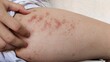 © Rung Kh - close up the fingers scratching the rash, hives, allergy and inflammation skin, reaction and urticaria on the leg of the woman, health care and medical concept.