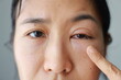 © TripleP Studio - Woman's eyes become inflamed after rubbing her eyes violently. Insects entering eye cause irritation and wounds to cornea, causing eye to become swollen and red. Ophthalmologist treats eye infections.