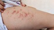 © Rung Kh - Portrait the rash, hives, allergy and inflammation skin, reaction and urticaria, scar and dark spots on the leg of the teenage girl, health care and medical concept.