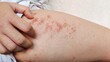 © Rung Kh - close up of a patient scratching the rash hives allergy and inflammation skin, reaction and urticaria, scar and dark spots on the leg of the woman, health care and medical concept.