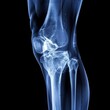 © bajita111122 - X-ray view of a knee joint, showing ligaments and bone alignment, medical analysis