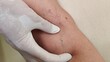 © Rung Kh - Portrait the varicose veins and spider, problem circulation of blood on the leg, wrinkle and Flabby skin, patient and illness of the woman, health care and medical concept.