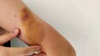 © Rung Kh - Portrait bruises on the arm, patient and illness of the woman, health care and medical concept.