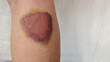 © Rung Kh - close up the bruises on the leg, illness and patient of the woman, health care and medical concept.