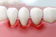 © piyaset - Gum disease and inflammation from Periodontitis. 3D rendering.