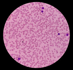 Wall Mural - PBF (peripheral blood film): Blood smear thalassemia showing hypochromia,schistocyte,NRC,Target cells. Severe thrombocytopenia.