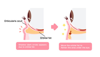 Wall Mural - How to remove dark circles under the eyes with Lower blepharoplasty (Transconjunctival blepharoplasty)