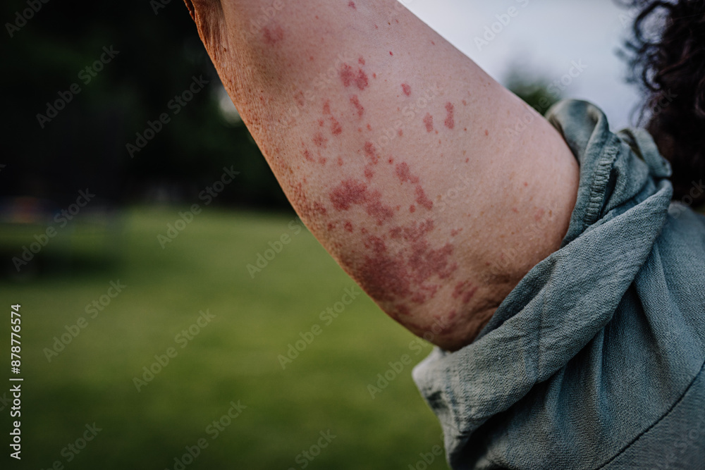 Parvovirus Reticlar Rash Close-up of a woman's arm showing a rash caused by Human Parvovirus ...