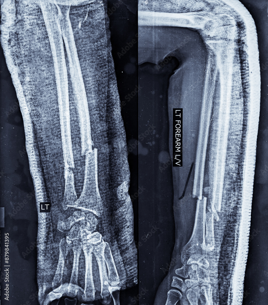 X ray image of forearm showing radius ulna fracture Stock Photo | Adobe ...