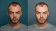© Daniel - before and after shot of a man before and after a hair transplant