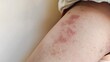 © Rung Kh - Portrait the rash hives allergic and reaction, scar and dullness, dry skin and wrinkle, disease and infection on the leg of the woman, health care and medical concept.