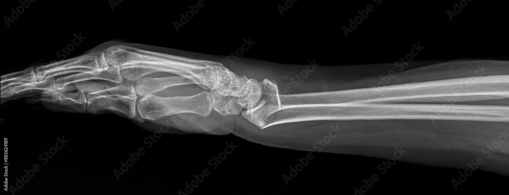 Plain radiograph of wrist in lateral projection on dark background ...
