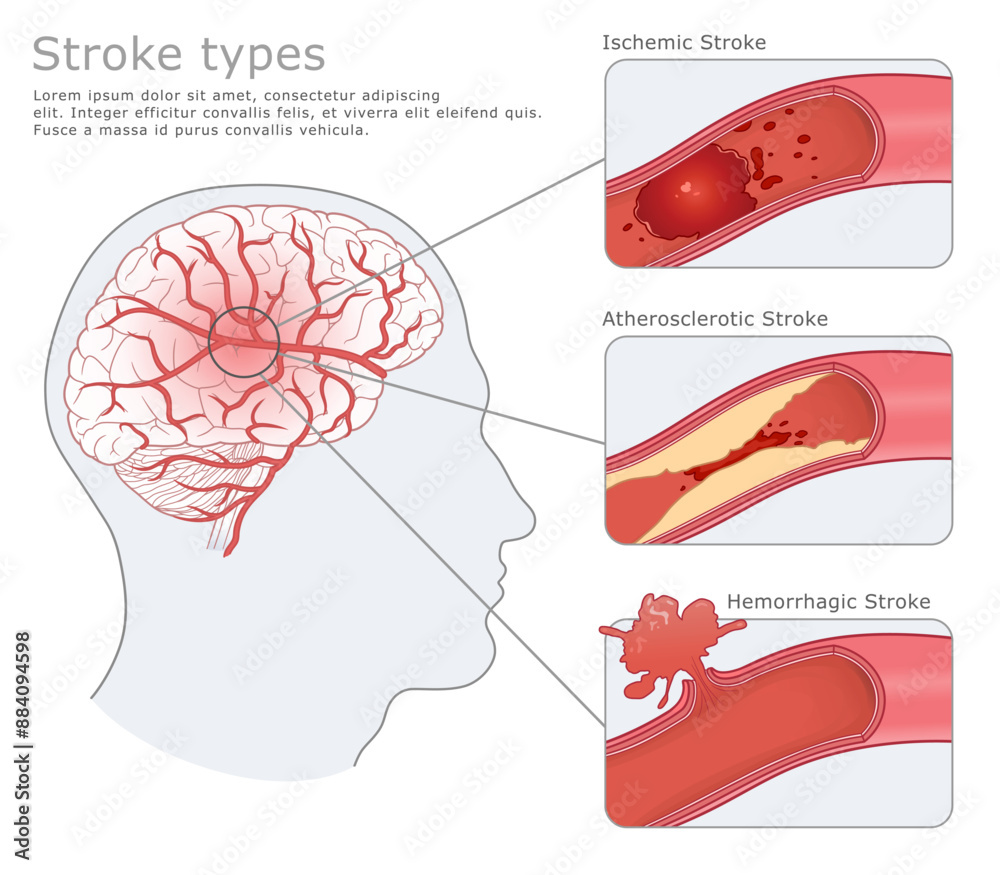 Damaged human brain after a Stroke and three types of Stroke. Vector ...