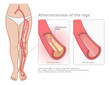 © Refluo - Peripheral arterial disease PAD medical diagram. Normal vessel and narrowed artery with atherosclerosis plaque. Medical vector illustration.