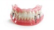 © ImageKing - Artificial teeth (dentures) supported by 4 implants in the lower jaw, shown on a white background.