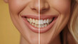 © VikaKa - An image featuring a before and after comparison of teeth whitening, split vertically