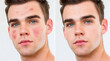 © Vector IMG - Rosacea & Skin Conditions : Men's Faces, Before After Treatment. Close-up of Couperose, Vascular Stars, Capillaries, Freckles, Back Rashes. Dermatology Insights