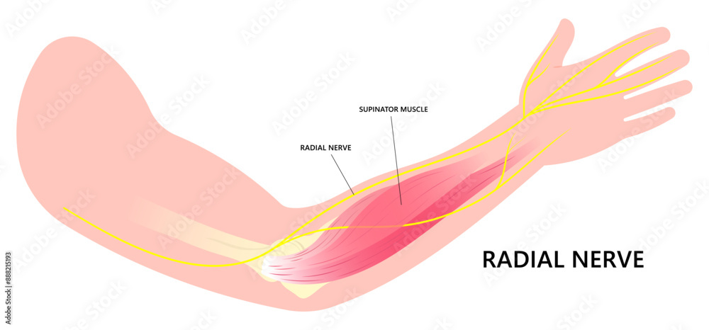 Anatomy of Radial tunnel syndrome with compressed nerve of Tinel's and ...