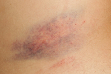 Wall Mural - close up view of a nasty bruise