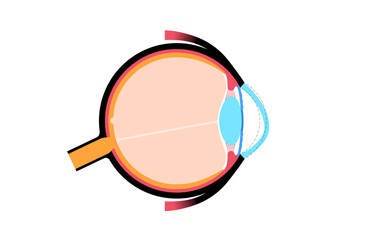 Sticker - Cataract eye disease