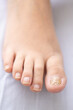 © Oscar_Alba - Foot with Big Toe Nail with Onychomycosis