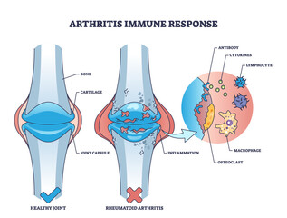 Canvas Print - Arthritis immune response with rheumatoid bone disease outline diagram, transparent background. Labeled educational medical condition with painful joints and inflammation illustration.