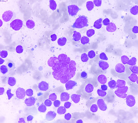 Poster - Bone marrow study smear picture of Acute Myeloid Leukemia, Blast cell, Granulopoiesis. Hematology. Blood cancer.