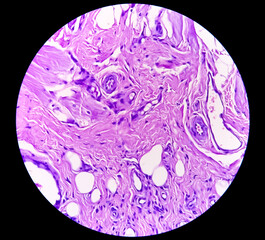 Poster - Microscopic examination showing Leukoplakia, buccal mucosa leukoplakia