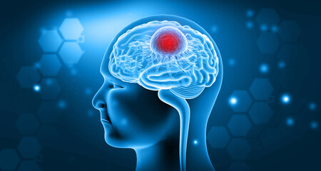 Wall Mural - Human brain cancer, tumour. 3d illustration