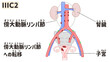 © koyuki - Endometrial cancer (Uterine cancer) Stage 3C2 diagram PNG