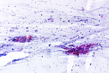 Canvas Print - Paps smear: NILM with reactive cellular changes associated with inflammation.