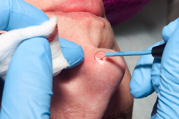 Closeup of hand of surgeon at work using medical instrument for electrocoagulation to remove benign tumor on the nose of middle aged patient.