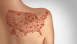 © freshidea - US Measles Outbreak and Increase in infection cases concept as a rising deadly outbreak disease and viral illness as a contagious chickenpox or a skin rash.