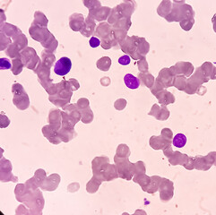 Canvas Print - Bone marrow study (BMS). Secondary metastasis  in bone marrow. Cancer cell. Oncology, cancerology, Bone marrow (BM) metastasis (BMM).