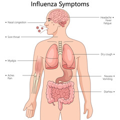 Wall Mural - symptoms of influenza in different parts of the human body diagram hand drawn schematic raster illustration. Medical science educational illustration