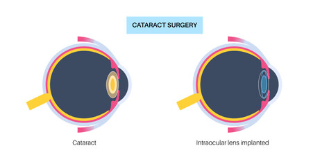 Canvas Print - Intraocular lenses poster